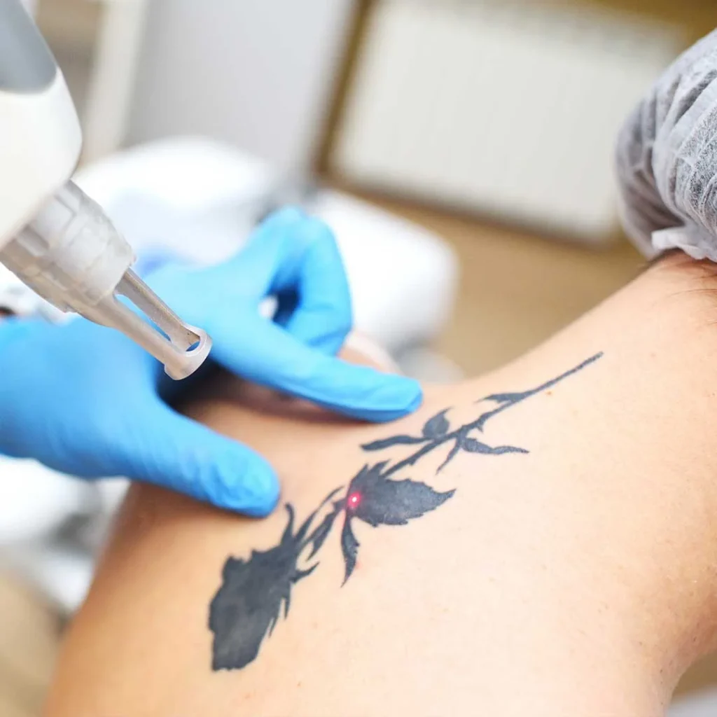 Tattoo Removal Laser