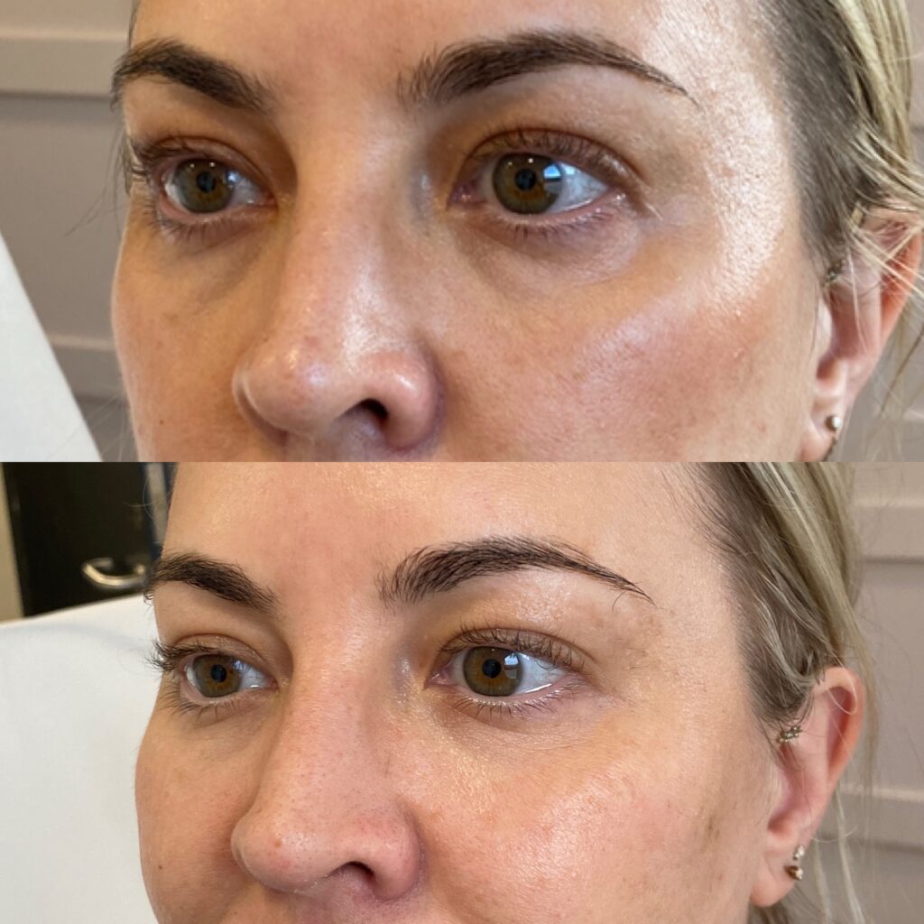 Under Eye Dark Circle Treatment