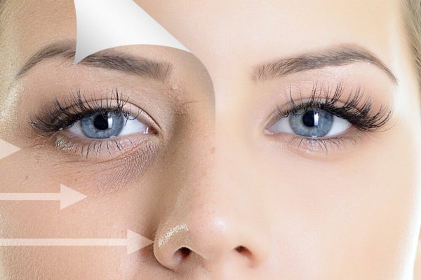 Under Eye Fillers