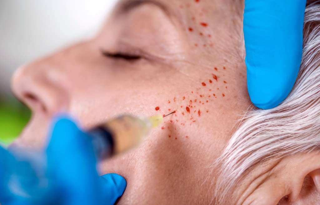 Vampire Facial