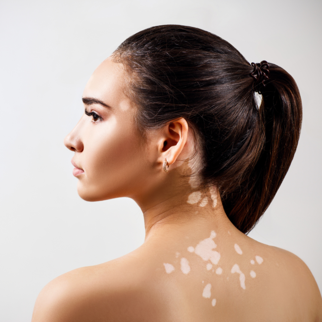 Vitiligo & Leucoderma Treatment
