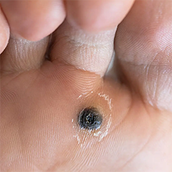 Wart Removal Treatment