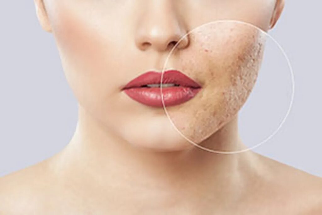 Laser Acne Treatment