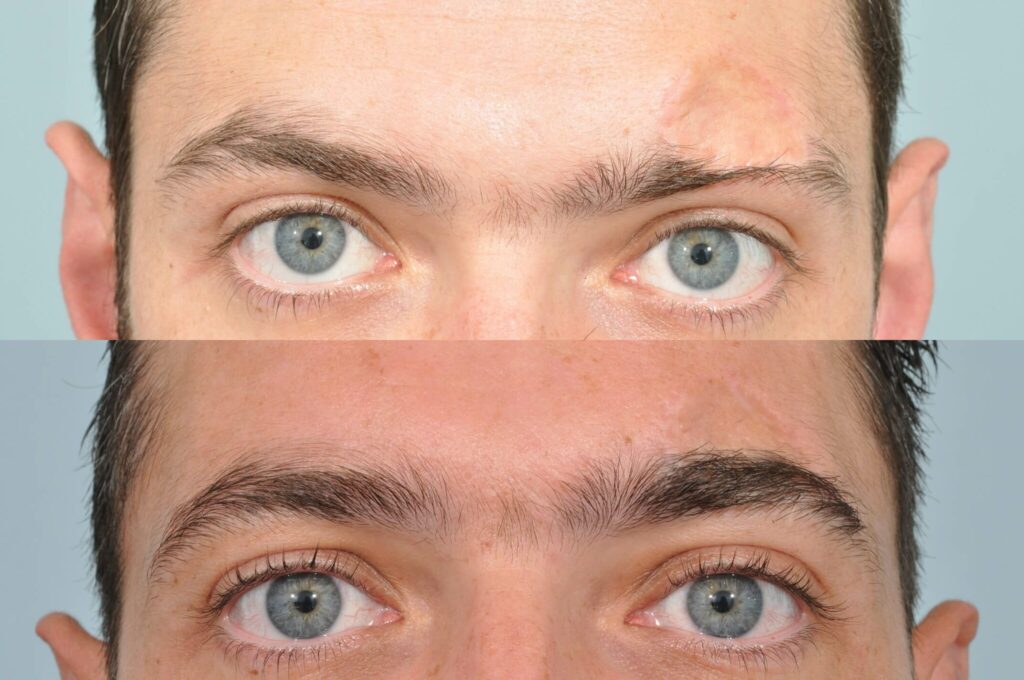 Eyebrow Hair Transplant