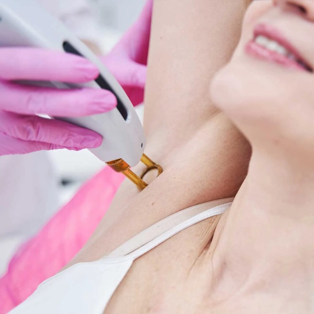 Laser Hair Removal