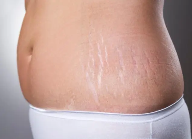 Stretch Mark Treatment