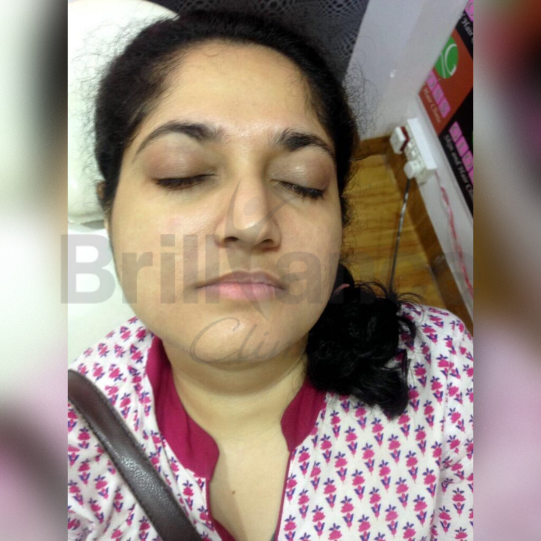 After image of Glutathione IV Drip Skin Brightening Treatment from Brilliance Cosmcoare Hair, Skin & Weightloss Clinic in Dn Nagar, Andheri West, Mumbai