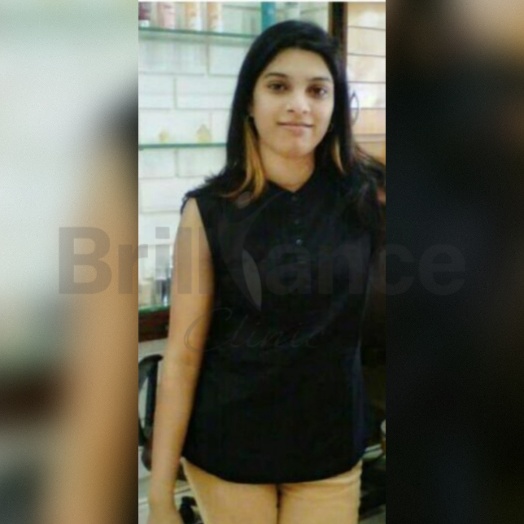 After image of Glutathione IV Skin Brightening Treatment from Brilliance Cosmcoare Hair, Skin & Weightloss Clinic in Dn Nagar, Andheri West, Mumbai