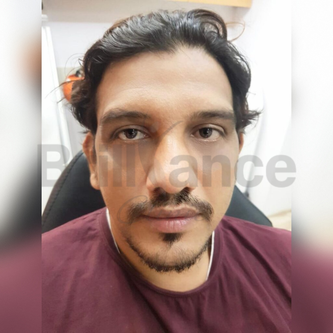After image of Laser + Peeling + Glutathione Combination Skin Treatment from Brilliance Cosmcoare Hair, Skin & Weightloss Clinic in Dn Nagar, Andheri West, Mumbai