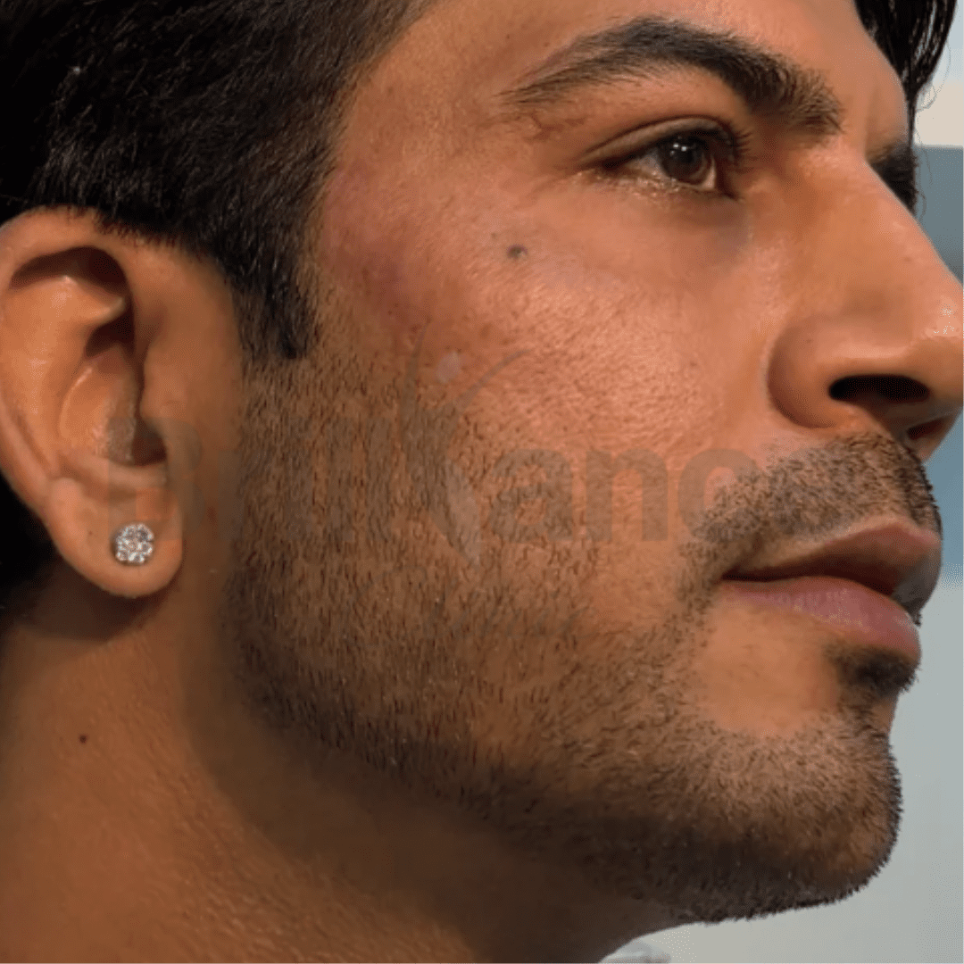 After image of Thread Lifting & Filler Treatment for Face Lifting and Jawline Enhancement ,from Brilliance Cosmcoare Hair, Skin & Weightloss Clinic in Dn Nagar, Andheri West, Mumbai