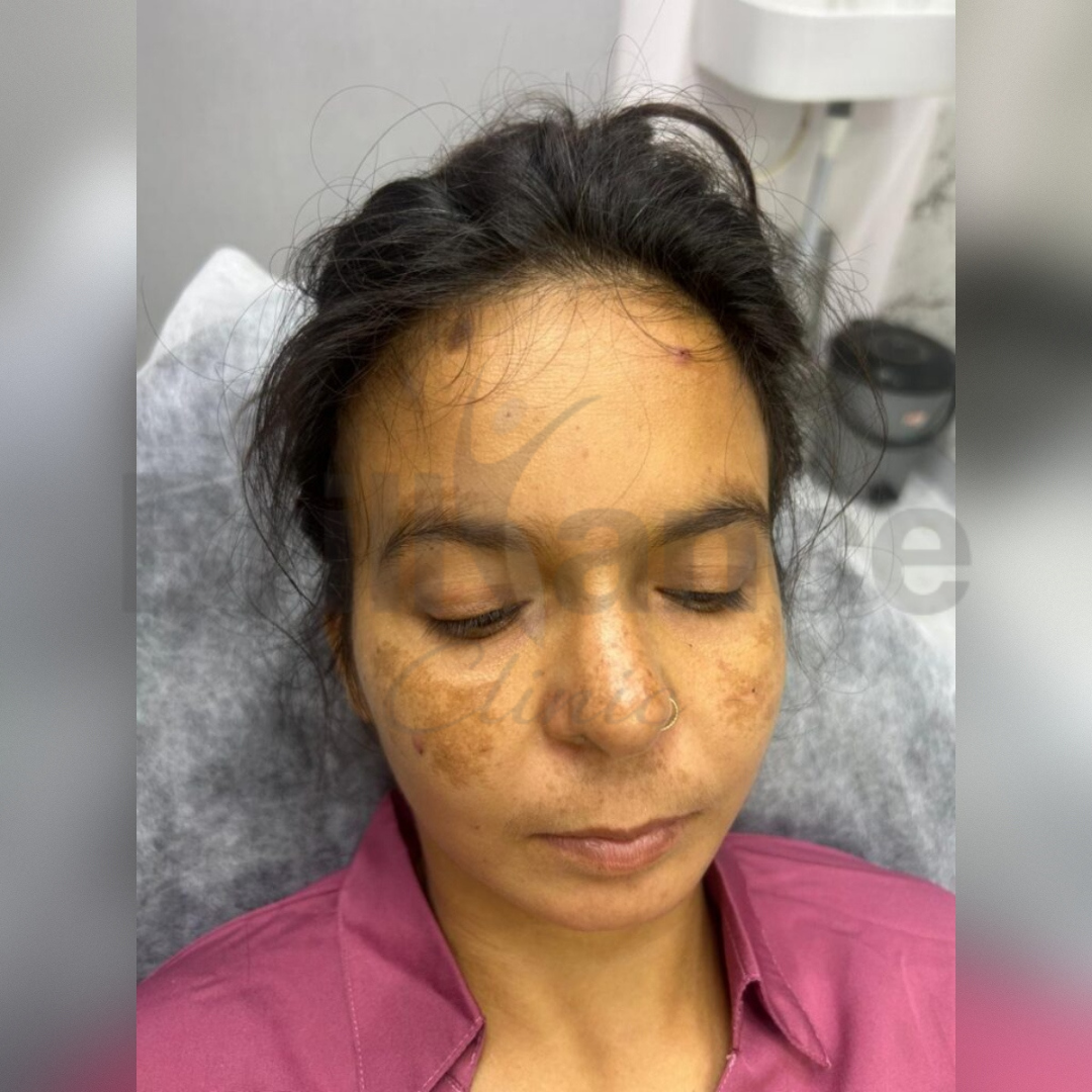 Before Image Glutathione + Laser + Chemical Peeling Treatment by Brilliance Cosmocare Hair, Skin & Weightloss Treatment in DN Nagar, Andheri West, Mumbai