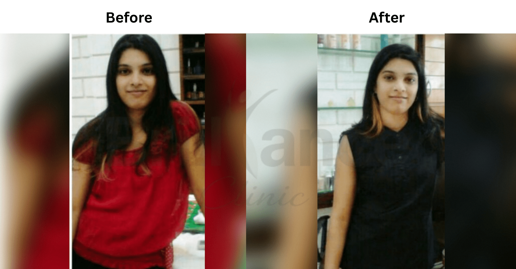 Before and after Glutathione IV skin brightening result for Aisha M.
