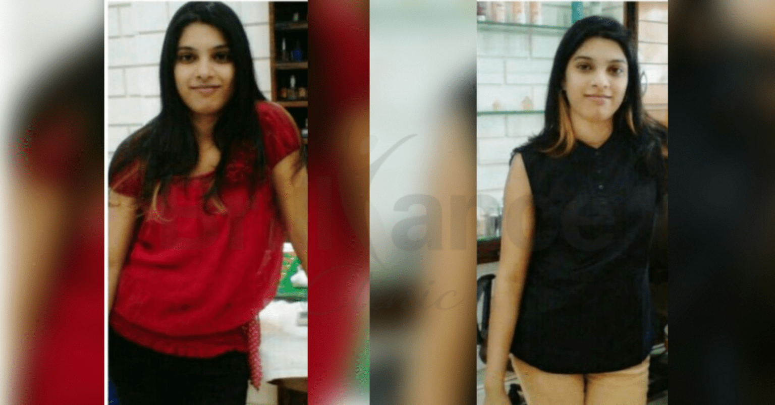 Before and After Image for Glutathione IV Skin Brightening Treatment