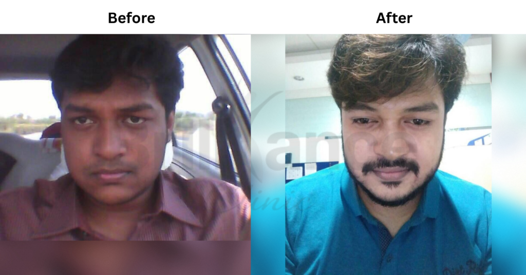 Before and After Image for Glutathione IV Skin Health Protocol