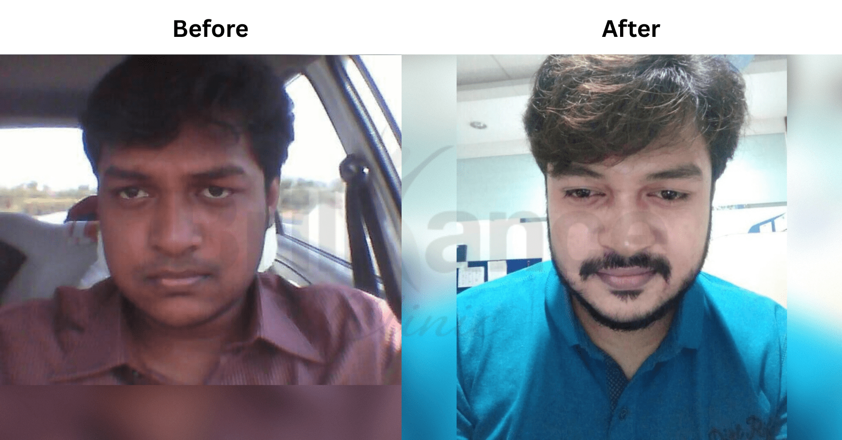 Before and after Glutathione IV skin health protocol for Rahul P.