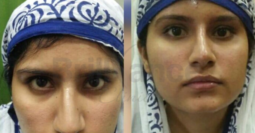 Before and After Treatment for Non-Surgical Rhinoplasty (Dermal Fillers)
