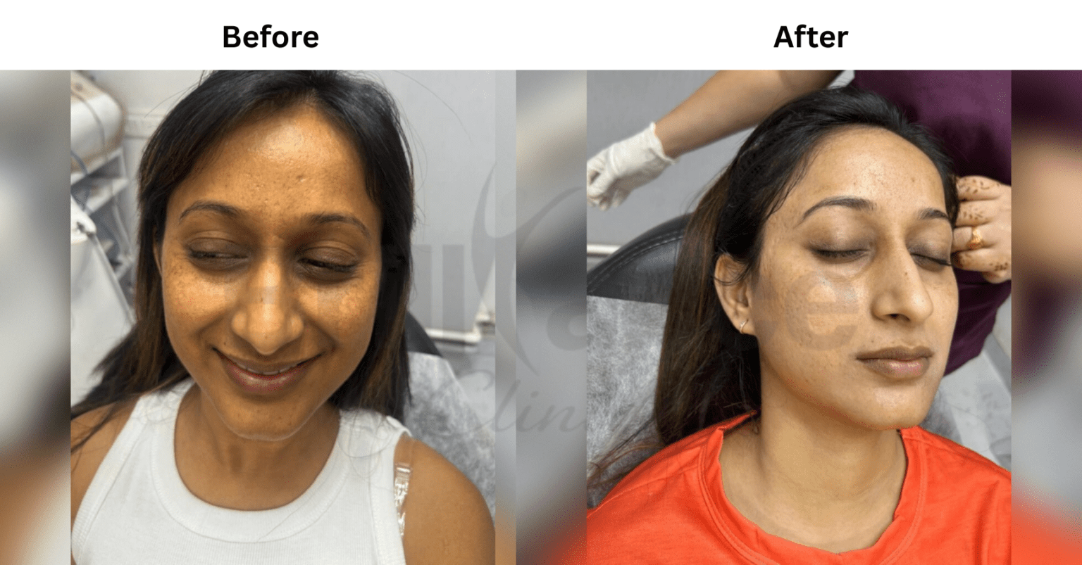 Before and After image of Glutathione + Chemical Peeling Protocol Skin Treatment from Brilliance Cosmcoare Hair, Skin & Weightloss Clinic in Dn Nagar, Andheri West, Mumbai