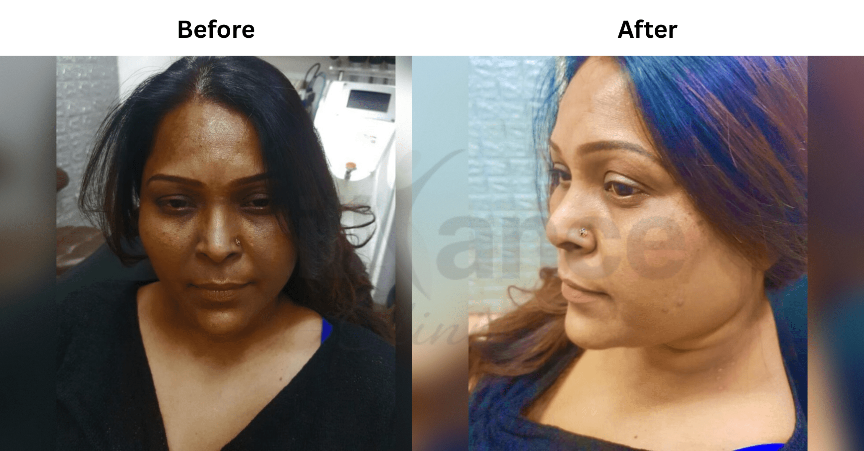 Before and after Glutathione + Chemical Peel skin treatment for Meera S.