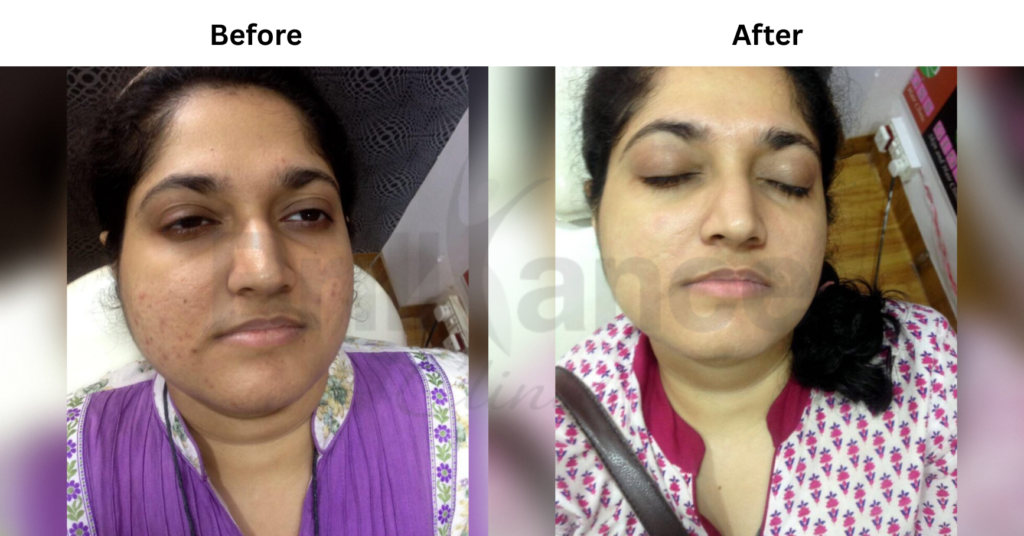 Before and After image of Glutathione IV Drip Skin Brightening Treatment from Brilliance Cosmcoare Hair, Skin & Weightloss Clinic in Dn Nagar, Andheri West, Mumbai