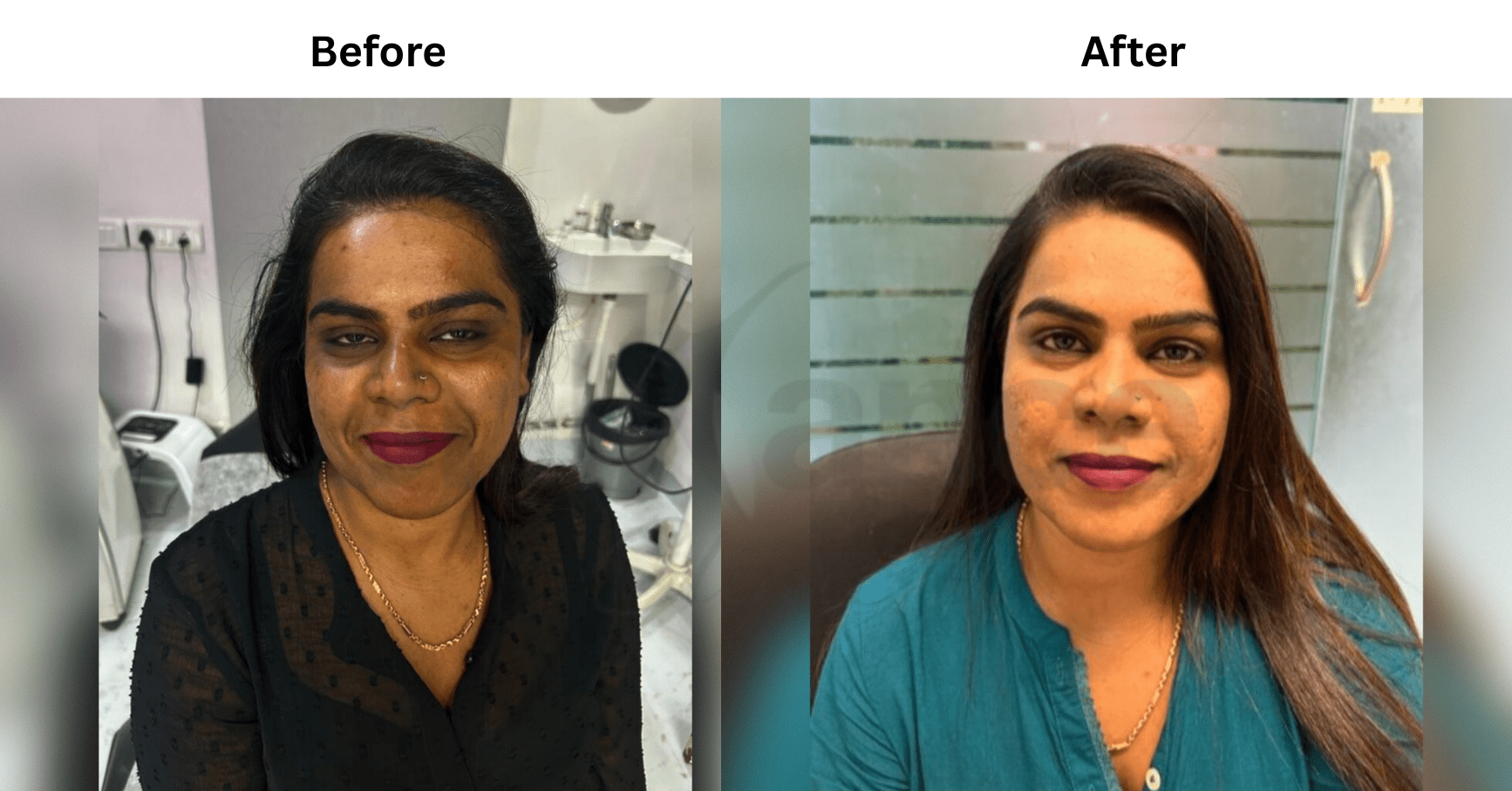Before and after Glutathione + Chemical Peel combination protocol for Pooja N.