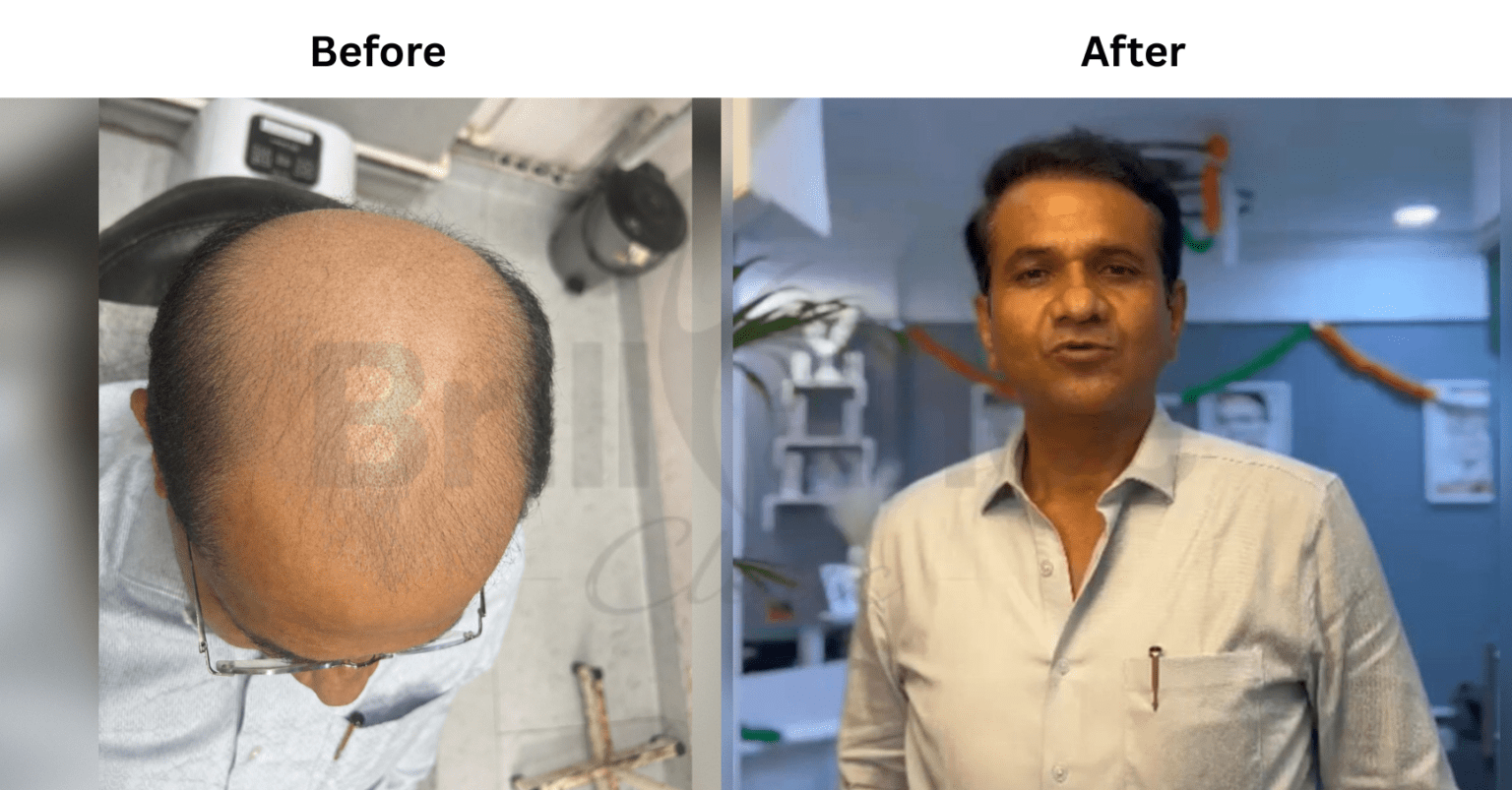 Before and After image of Hair Transplant (FUE Technique) from Brilliance Cosmcoare Hair, Skin & Weightloss Clinic in Dn Nagar, Andheri West, Mumbai