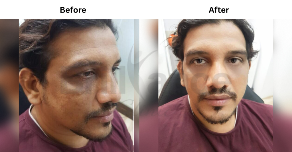 Before and After image of Laser + Peeling + Glutathione Combination Skin Treatment from Brilliance Cosmcoare Hair, Skin & Weightloss Clinic in Dn Nagar, Andheri West, Mumbai
