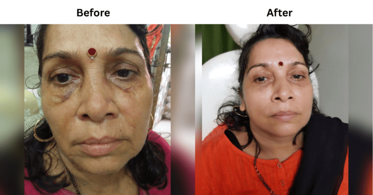 Before and After image of PDO Thread Lift Treatment from Brilliance Cosmcoare Hair, Skin & Weightloss Clinic in Dn Nagar, Andheri West, Mumbai (1)