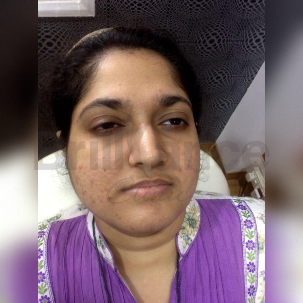 Before image of Glutathione IV Drip Skin Brightening Treatment from Brilliance Cosmcoare Hair, Skin & Weightloss Clinic in Dn Nagar, Andheri West, Mumbai
