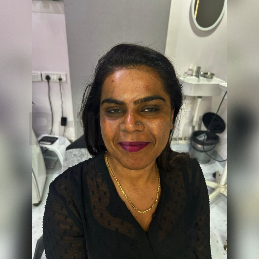 Before image of Glutathione + Skin Peeling Combination Protocol Treatment from Brilliance Cosmcoare Hair, Skin & Weightloss Clinic in Dn Nagar, Andheri West, Mumbai