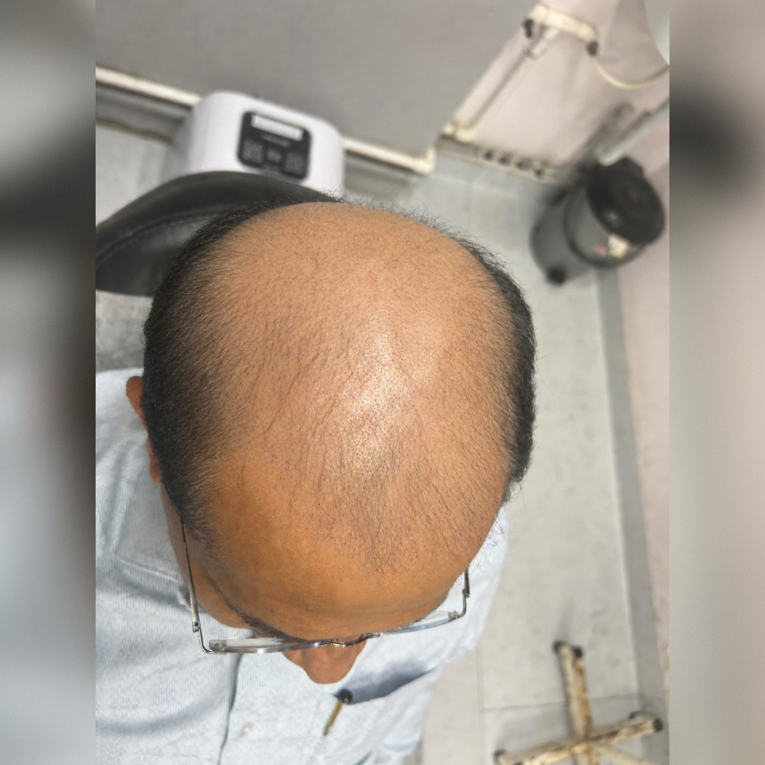 Before image of Hair Transplant (FUE Technique) from Brilliance Cosmcoare Hair, Skin & Weightloss Clinic in Dn Nagar, Andheri West, Mumbai