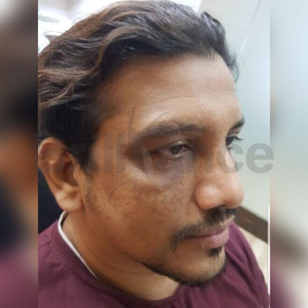 Before image of Laser + Peeling + Glutathione Combination Skin Treatment from Brilliance Cosmcoare Hair, Skin & Weightloss Clinic in Dn Nagar, Andheri West, Mumbai