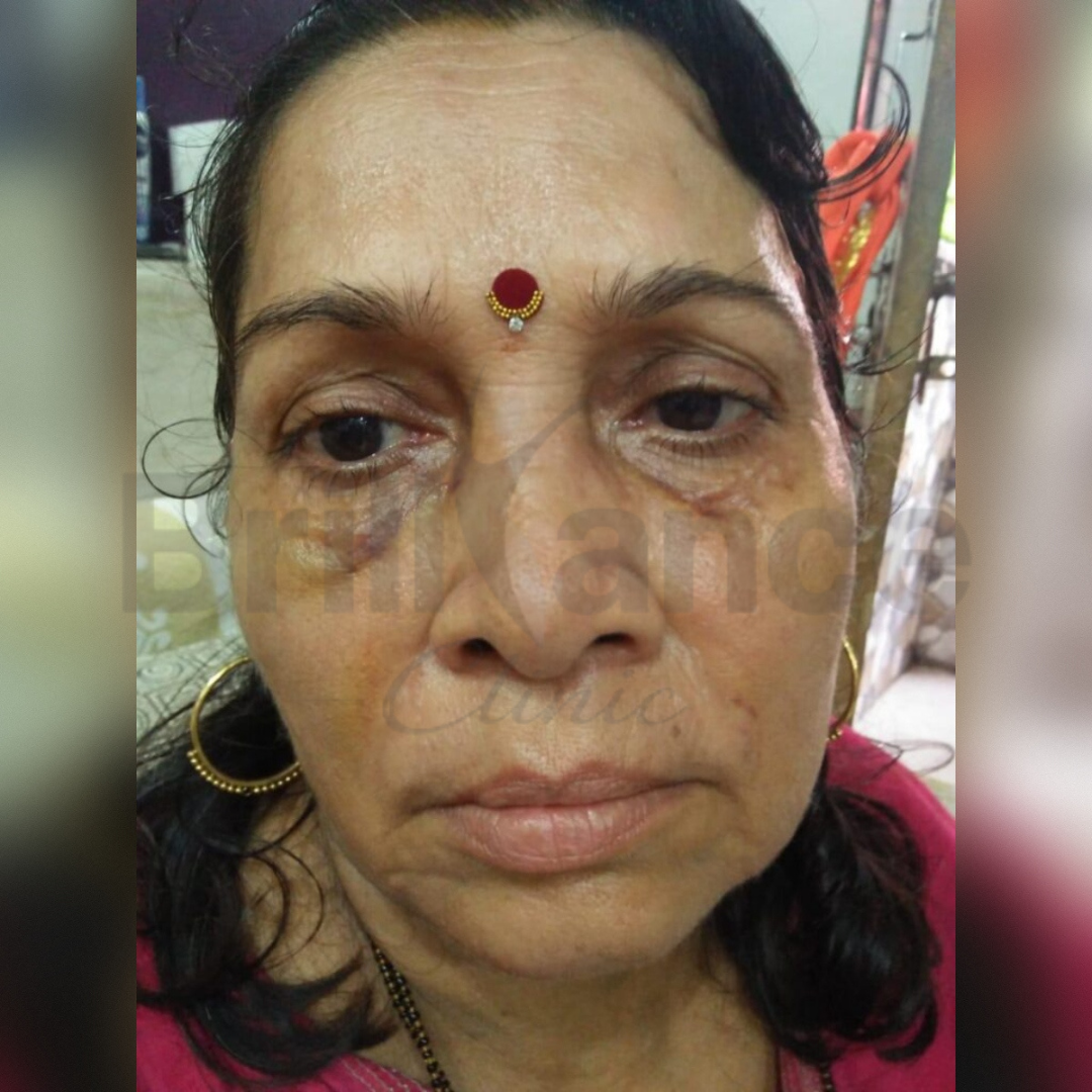 Before image of PDO Thread Lift Treatment from Brilliance Cosmcoare Hair, Skin & Weightloss Clinic in Dn Nagar, Andheri West, Mumbai