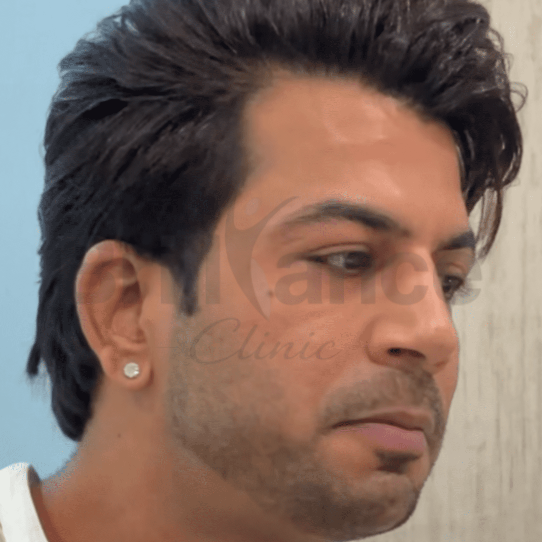 Before image of Thread Lifting & Filler Treatment for Face Lifting and Jawline Enhancement ,from Brilliance Cosmcoare Hair, Skin & Weightloss Clinic in Dn Nagar, Andheri West, Mumbai