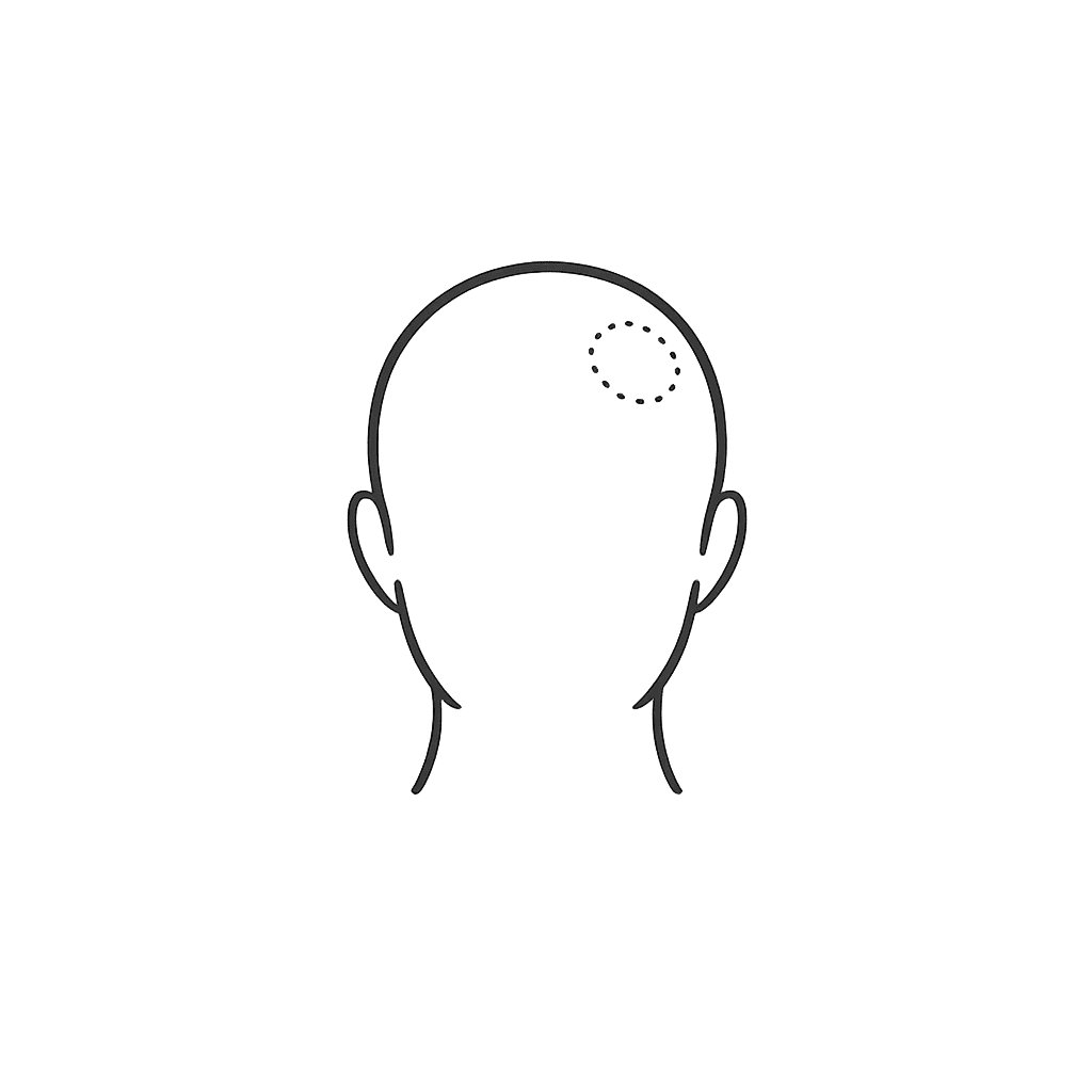 Alopecia areata icon for hair treatment at Brilliance Cosmocare Skin Hair and Weightloss Treatment in Andheri Mumbai