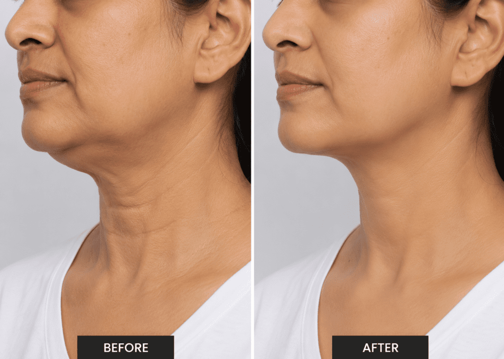 Neck Rejuvenation Treatment