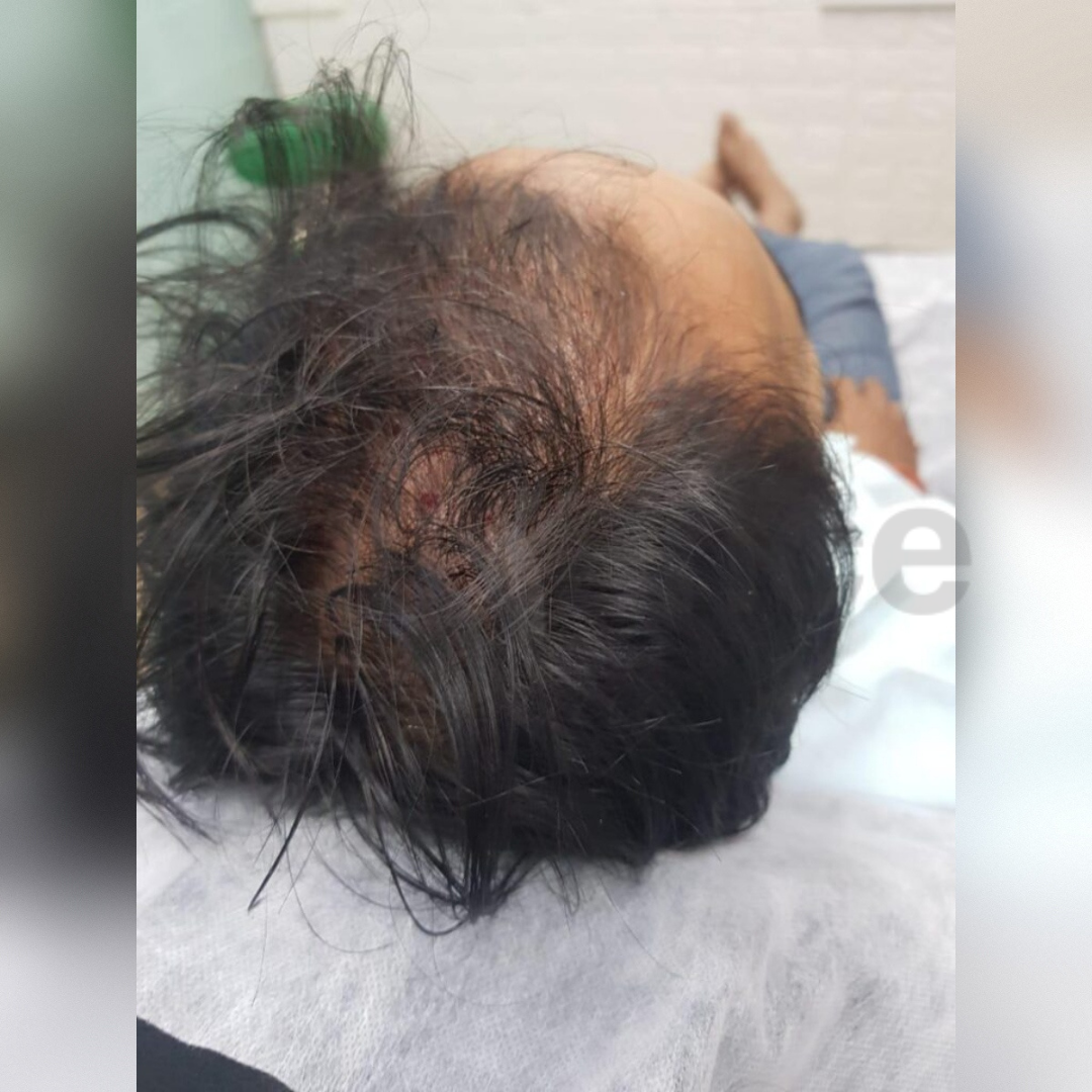 GFC Hair Treatment Before Image by Brilliance Cosmocare Skin, Hair & Weightloss Clinic in Dn Nagar, Andheri, Mumbai