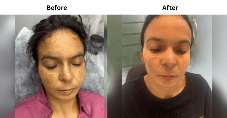 glutathione transformation Understanding Injection Before and After The truth about Glutathione!