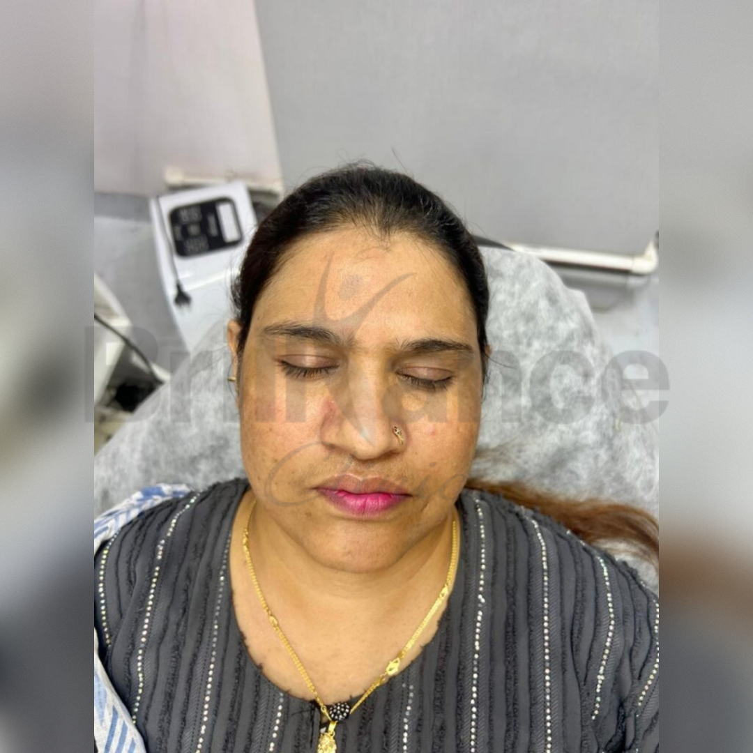 Melasma Reduction Treatment After Image by Brilliance Cosmocare Hair, Skin & Weightloss Treatment