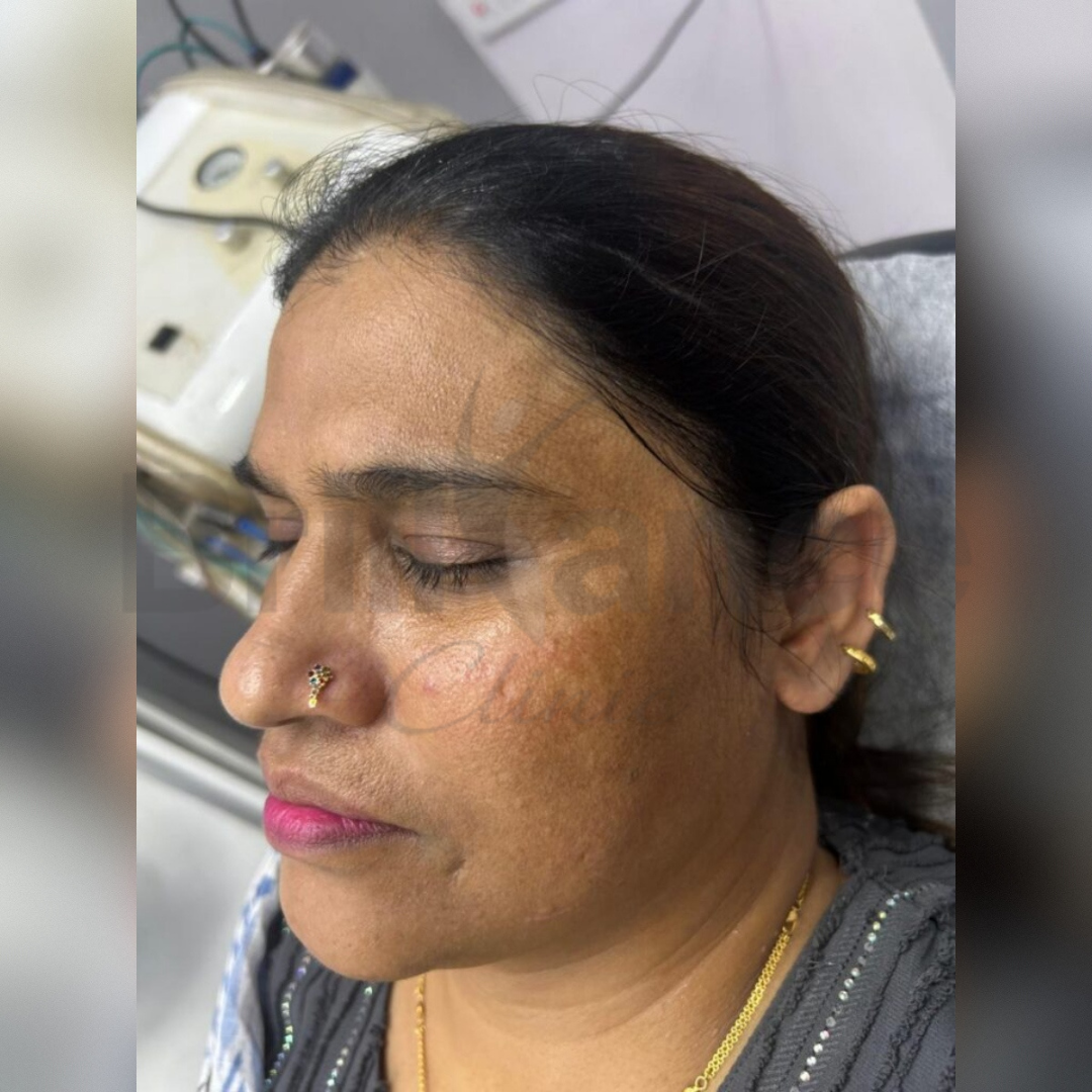 Melasma Reduction Treatment Before Image by Brilliance Cosmocare Hair, Skin & Weightloss Treatment