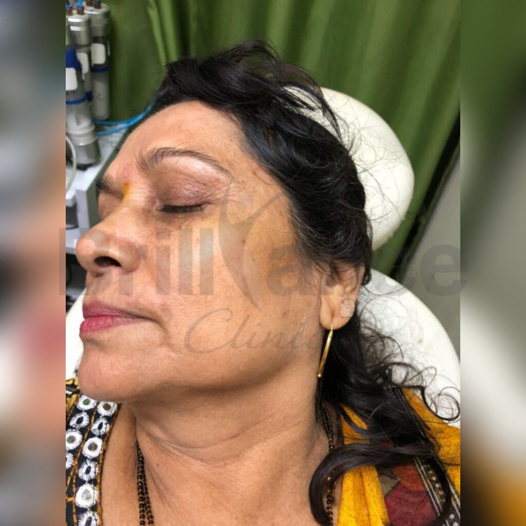 Middle image of PDO Thread Lift Treatment from Brilliance Cosmcoare Hair, Skin & Weightloss Clinic in Dn Nagar, Andheri West, Mumbai