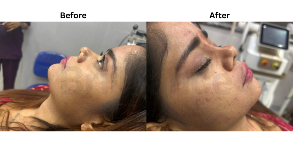 Nose Filler Treatment Tranformation Casestudy by Brilliance Cosmocare Hair, Weight, Skin Clinic in DN Nagar, Andheri West, Mumbai