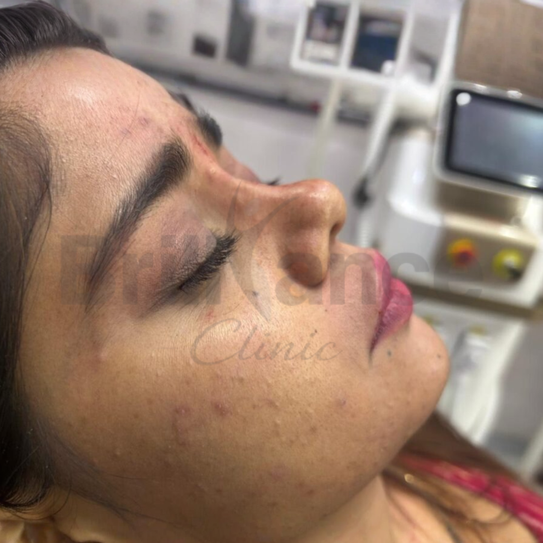 Riya M. After Image for Non-Surgical Rhinoplasty with Dermal Fillers Treatment By Brilliance Cosmocare Skin, Hair & Weightloss Treatment