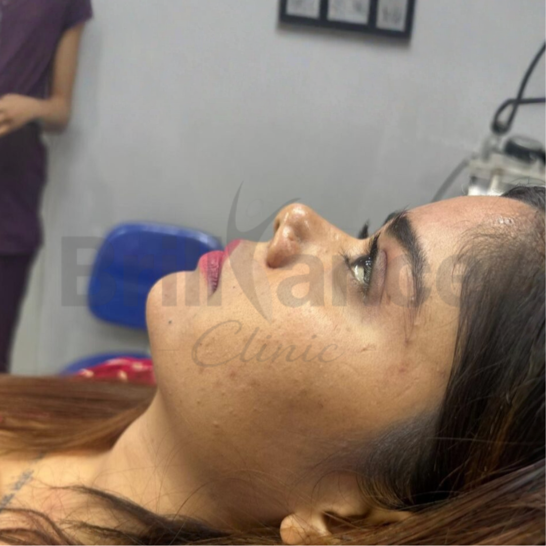 Riya M. Before Image for Non-Surgical Rhinoplasty with Dermal Fillers Treatment By Brilliance Cosmocare Skin, Hair & Weightloss Treatment
