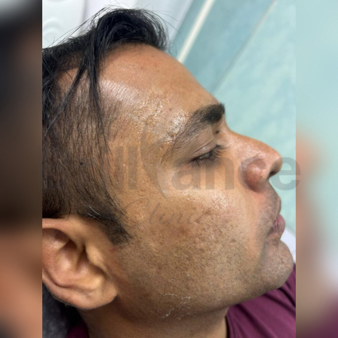 Scar Removal Treatment After Image at Brilliance Cosmocare Hair, Skin & Weightloss Clinic in Dn Nagar Andheri West Mumbai