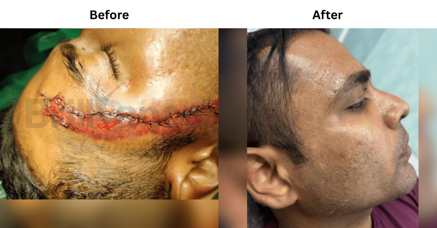 Scar Removal Treatment Transformation Casestudy by Brilliance Cosmocare Skin, Hair & Weightloss Clinic in DN Nagar, Andheri, Mumbai
