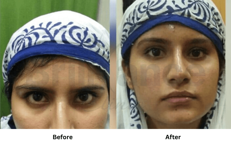 profhilo-skin-texture-hydration-improvement-results-mumbai (24)