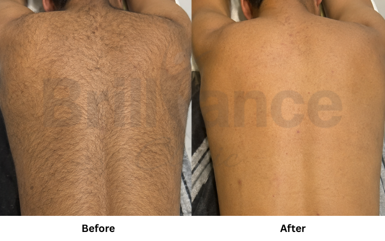 leaser hair removal