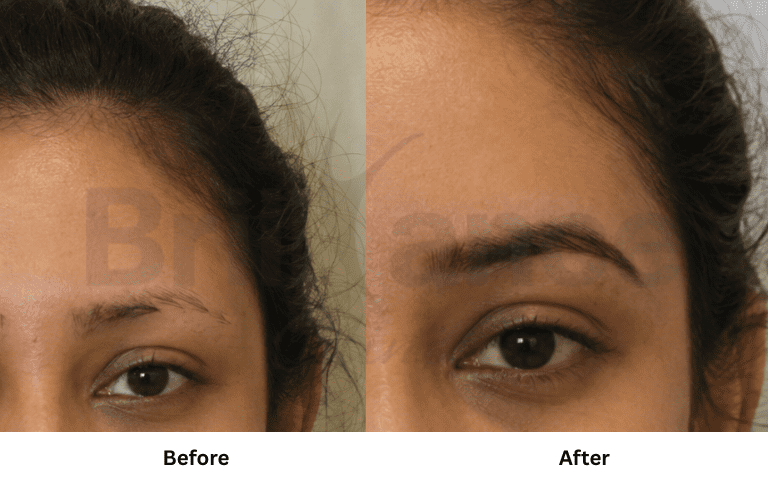 eyebrow hair transplant