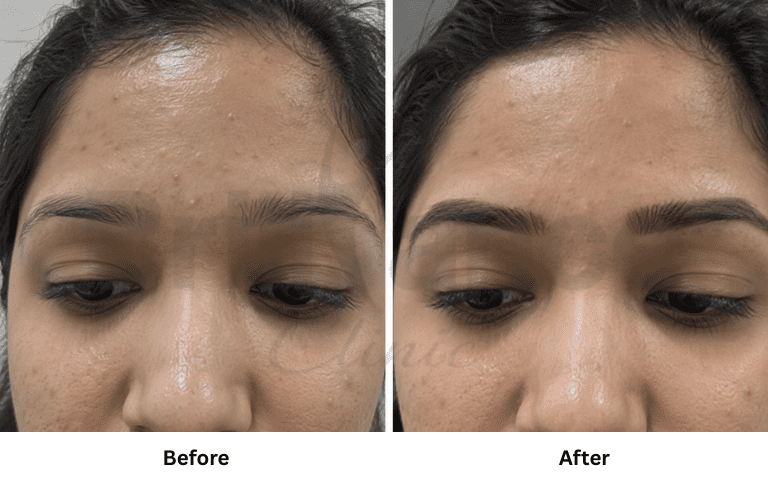 eyebrow hair transplant