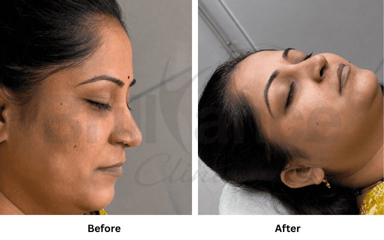 profhilo-skin-texture-hydration-improvement-results-mumbai (12)